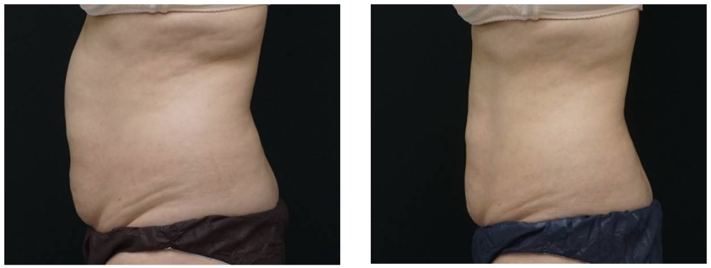 Efekty kriolipolizy: usunięcie opornej tkanki tłuszczowej na brzuchu