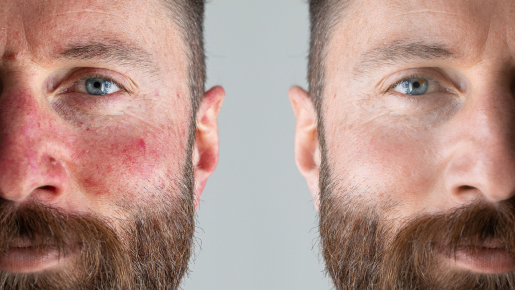 Leczenie trądziku różowatego laserem