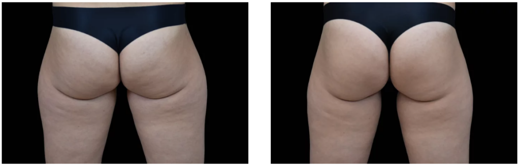 Modelowanie pośladków zabiegiem BTL – efekty