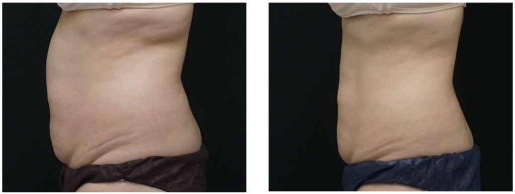 Kriolipoliza – efekty wyszczuplania brzucha