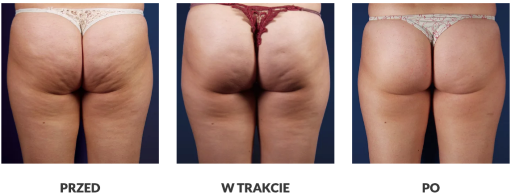 Efekty zastosowania fali uderzeniowej na ciało