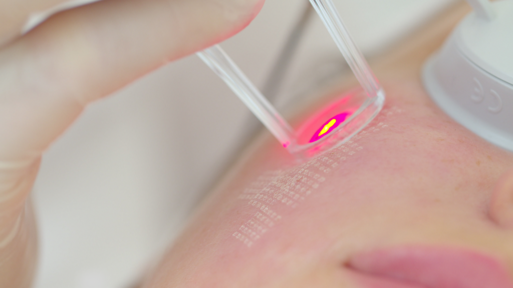 Laser frakcyjny – zabieg na twarzy