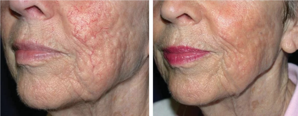 Leczenie rumienia laserem IPL – efekty