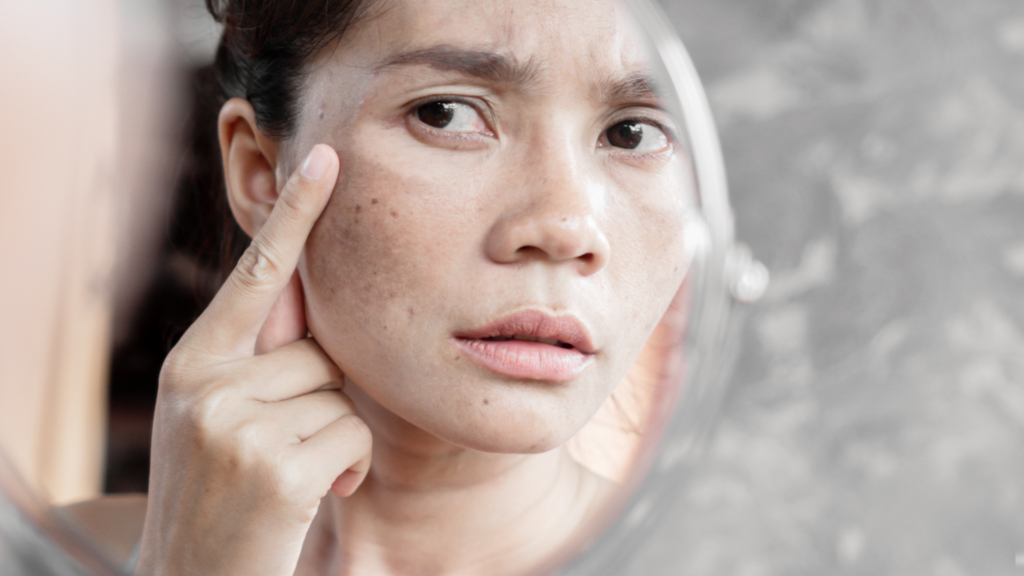 Oznaki fotostarzenia: przebarwienia, szary koloryt cery, zmarszczki