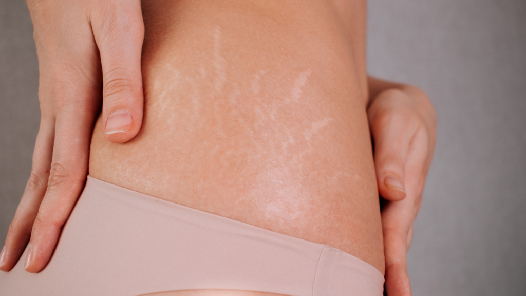 Rozstępy zanikowe, czyli stare